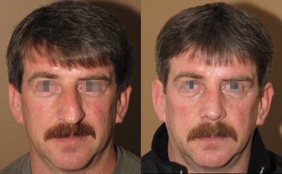 Rhinoplasty/nose job - 
	Rhinoplasty/nose job male
