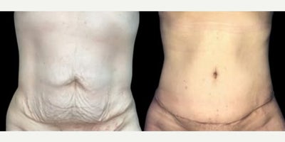 Woman treated with Tummy Tuck - Woman treated with Tummy Tuck