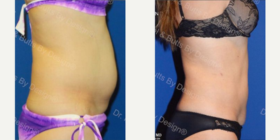 Woman treated with Vaser Liposuction - Woman treated with Vaser Liposuction