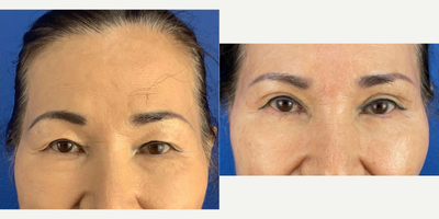 65-74 year old woman treated with Eyelid Surgery - Patient received bilateral upper blepharoplasty and brow pexy to get rid of excess skin, open up eyes, improve appearance and vision.