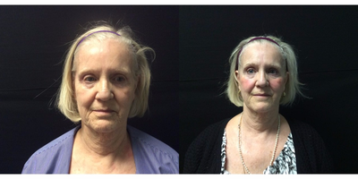 72 year old woman treated with Ultherapy - 72 year old female treated with Ultherapy full face and neck