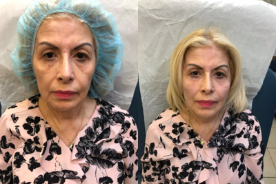 55-64 year old woman treated with Bellafill - Long lasting bio stimulating agent , with immediate results which improve over time . 15 min procedure with no or minimal downtime .