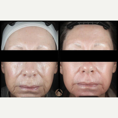 CO2 Laser - CO2RE, Fractional CO2 Resurfacing treatment