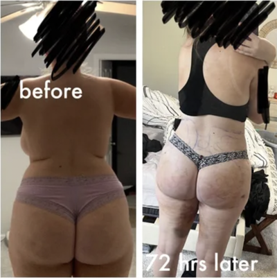 AirSculpt - Arms & Full Abdomen + BBL Fat Transfer to Butt 