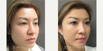 25-34 year old woman treated with Asian Eyelid Surgery - Asian Double Eyelid Surgery with non-incision Suture Only technique in restoring eyelid symmetry and enhancing lid crease definition