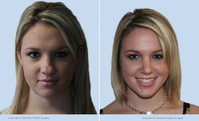 rhinoplasty - Rhinoplasty, Nose tip.