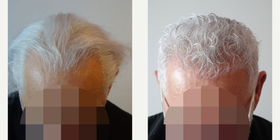 55-64 year old man treated with FUE Hair Transplant - 1023 grafts - 1 hair (1023) 1210 grafts - 2 hair (2420) 967 grafts - 3 hair (2901)
In total : 3200 grafts - 6344 hair En Total : 3100 injertos - 6242 pelos