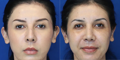 Woman treated with Rhinoplasty - Rhinoplasty