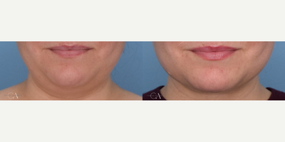 32 year old woman treated with Chin Liposuction - 32 year old patient concerned with under-chin fat. Neck liposuction is done with Dr.Cheryl Karcher.Photos pictured: 2 months post-surgery. Results will continue to improve up to 6 months.