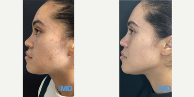 25-34 year old woman treated with Pico Genesis, Skin Rejuvenation, Skin Lightening - This lovely lady had amazing results after our PICO Genesis Treatment & DiamondGlow Facial Combo!!!