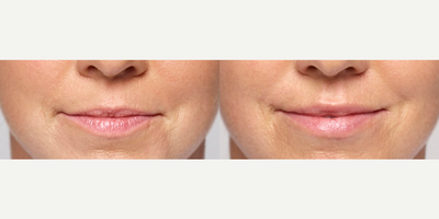 Woman treated with Restylane Silk - Photo provided courtesy of Galderma