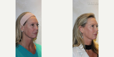 Nuface - The Nu Skin Rejuvenation Procedure utilizes your own regenerative (stem) cells and fat tissue to replace voume loss in the face and body.