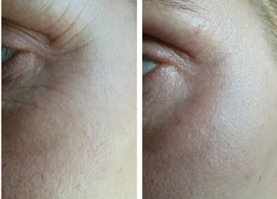 45-54 year old woman treated with Laser Treatment - Plasma Fibroblast Crows Feet