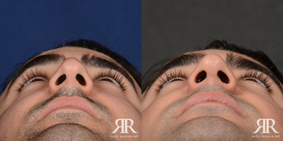 Man treated with Rhinoplasty - Man treated with Rhinoplasty