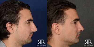 Man treated with Rhinoplasty - Man treated with Rhinoplasty