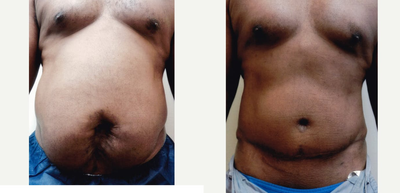 55-64 year old man treated with Tummy Tuck - Abdominoplasty on male 3 months post-op