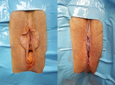 25-34 year old woman treated with Vaginal Rejuvenation - 35 year old woman treated vaginoplasty and labiaplasty. Photos are pre op and immediately after surgery.