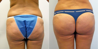25-34 year old woman treated with Butt Augmentation - Liposuction to the abdomen, back and waistline with fat transfer to the buttock.