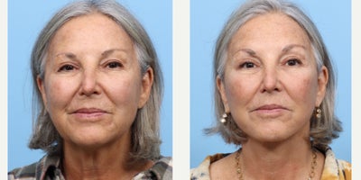 65-74 year old woman treated with Deep Plane Facelift - This patient came to Dr. Wise with complaints of excess submental and jowls, and visible signs of aging. Dr. Wise performed a deep plane facelift, resulting in a rejuvenated, refreshed appearance.