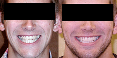 Invisalign - Invisalign