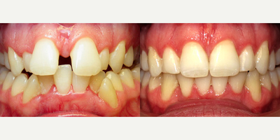 Invisalign - Invisalign