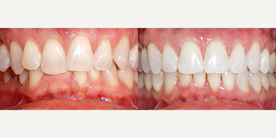 Invisalign - Invisalign