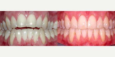 Invisalign - Invisalign
