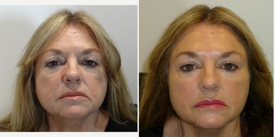 55-64 year old woman treated with Teosyal - Patient presented with concerns about general improvement tosigns of ageing. Treated with Botox to Forehead, between brows and crows feet and dermal filler to cheeks, nose-to-mouth lines and lips. Also had course of Profhilo to general improvement of skin tone and texture.