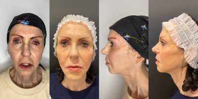 55-64 year old woman treated with Ellanse - Patient underwent treatment for breast cancer last year, lost weight, confidence and self esteem.Following her chemotherapy she lost her hair and had marked skin thinning.Treatment plan was a full face restoration using Ellanse M to restore temple volume, midface, jawline and chin.A total of 8 mls was used. Maili Define HA was used for her lips.