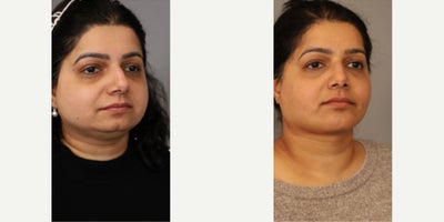 Woman treated with Neck Lift - Woman treated with Neck Lift, Chin Implant, and Cheek Liposuction to address fullness of her face.