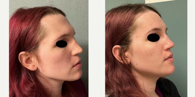 25-34 year old woman treated with Brow Bone Reduction, Forehead Reduction, Brow Lift, Rhinoplasty, Lip Lift - this is a young lady who under forehead reconstruction, septorhinoplasty, lip lift, and anterior mandible/chin feminization.