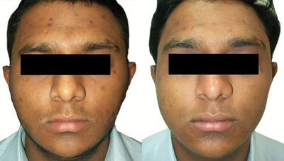 Venus Viva - Before and After 3 Treatments. &nbsp;Photos provided courtesy of Venus Concept, performed by Megha Joy Shah, MD.