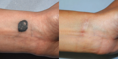 18-24 year old woman treated with Scar Removal - Tattoo removal from wrist. Simple surgical excision and closure with absorbable stitches.