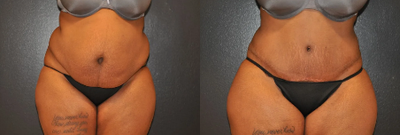 Woman treated with Tummy Tuck - Woman treated with Tummy Tuck