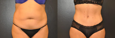 Woman treated with Tummy Tuck - Woman treated with Tummy Tuck