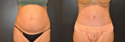 Woman treated with Tummy Tuck - Woman treated with Tummy Tuck