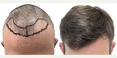 31 year old man treated with Rogaine - This is a 31-year-old male patient with a 10-year history of hair loss manifested as slowly enlarging recessions in the hairline. The left side was thinning at a faster rate than the right.Wed previously talked in consultation about 4 months prior to his surgery and at that time he wasnt taking any steps to preserve his existing hair. Following our conversation, he started using the Biolightlow-level laser therapy cap and had been using this for about 4 months prior to his surgery.We performed a 1316 graft FUE surgery with the main goal of restoring the hairline and filling in the recessions. We also added a little density behind his existing hairline to give the cosmetic effect of a fuller hairline overall. You can see from the operative drawing that we used an irregularly irregular pattern in the hairline to mimic a natural hairline while maintaining natural, masculine, sharp frontotemporal angles.Following his surgery, we started him on once-daily high-strength minoxidil to further optimize his existing hair and encourage the growth of his transplant follicles.He returned to us 15 months after his surgery with a result!He can now confidently wear his hair in any way he likes and he hasnt lost any more hair since starting his laser cap and minoxidil.