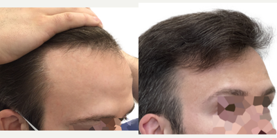 31 year old man treated with Rogaine - This is a 31-year-old male patient with a 10-year history of hair loss manifested as slowly enlarging recessions in the hairline. The left side was thinning at a faster rate than the right.Wed previously talked in consultation about 4 months prior to his surgery and at that time he wasnt taking any steps to preserve his existing hair. Following our conversation, he started using the Biolightlow-level laser therapy cap and had been using this for about 4 months prior to his surgery.We performed a 1316 graft FUE surgery with the main goal of restoring the hairline and filling in the recessions. We also added a little density behind his existing hairline to give the cosmetic effect of a fuller hairline overall. You can see from the operative drawing that we used an irregularly irregular pattern in the hairline to mimic a natural hairline while maintaining natural, masculine, sharp frontotemporal angles.Following his surgery, we started him on once-daily high-strength minoxidil to further optimize his existing hair and encourage the growth of his transplant follicles.He returned to us 15 months after his surgery with a result!He can now confidently wear his hair in any way he likes and he hasnt lost any more hair since starting his laser cap and minoxidil.