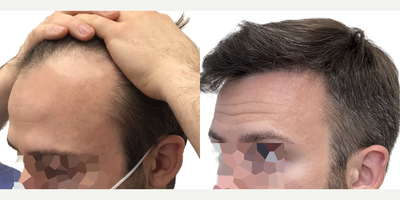 31 year old man treated with Rogaine - This is a 31-year-old male patient with a 10-year history of hair loss manifested as slowly enlarging recessions in the hairline. The left side was thinning at a faster rate than the right.Wed previously talked in consultation about 4 months prior to his surgery and at that time he wasnt taking any steps to preserve his existing hair. Following our conversation, he started using the Biolightlow-level laser therapy cap and had been using this for about 4 months prior to his surgery.We performed a 1316 graft FUE surgery with the main goal of restoring the hairline and filling in the recessions. We also added a little density behind his existing hairline to give the cosmetic effect of a fuller hairline overall. You can see from the operative drawing that we used an irregularly irregular pattern in the hairline to mimic a natural hairline while maintaining natural, masculine, sharp frontotemporal angles.Following his surgery, we started him on once-daily high-strength minoxidil to further optimize his existing hair and encourage the growth of his transplant follicles.He returned to us 15 months after his surgery with a result!He can now confidently wear his hair in any way he likes and he hasnt lost any more hair since starting his laser cap and minoxidil.
