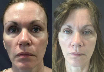 35-44 year old woman treated with Belotero - Patient had Belotero placed in tear trough for dark circles are hollowness.