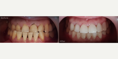 Full Zirconium Crowns, Biting Correction - Full Smile Makeover, Correction of a Class 3 Malocclusion to Class 1.