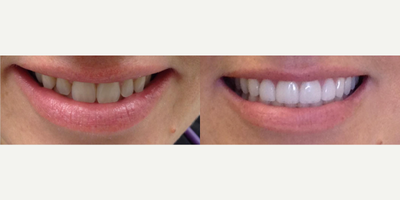Woman treated with Smile Makeover, Dental Bonding, Teeth Whitening - Woman treated with Smile Makeover, Dental Bonding, Teeth Whitening