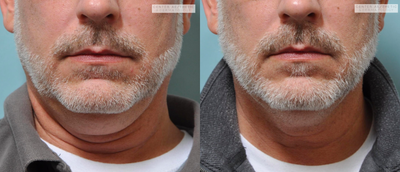 55-64 year old male treated with  Kybella - 1 Month Post Treatment -2 Vials of Kybella to Submental & Neck