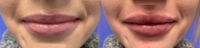 Woman treated with Lip Augmentation - Woman treated with Lip Augmentation