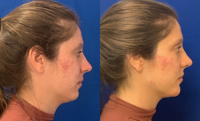Woman treated with Radiesse - My patient desired a more chiseled chin and jawline. I used 2 Radiesse on the chin and jawline and Restylane Lyft to her cheekbones.
