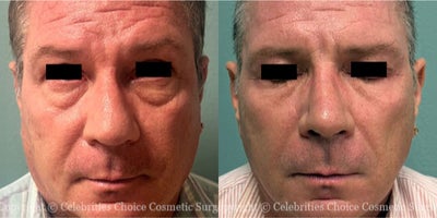Man treated with Revision Rhinoplasty, Eyelid Surgery - Man treated with Revision Rhinoplasty, Eyelid Surgery