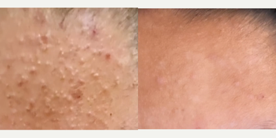 Patient treated with AviClear - Dont let acne ruin your day - Our patient just finished her 3rd AviClear session. The before & after results were taken between sessions 2 & 3.