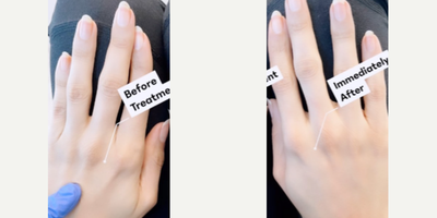 Woman treated with Hand Rejuvenation - Never forget your hands. Hand rejuvenation is easy with lasting results & minimal downtime.