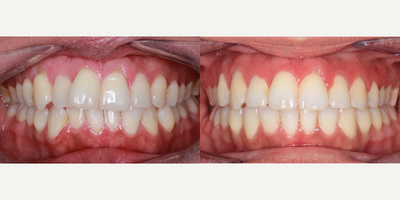 Woman treated with Braces - Woman treated with Braces.