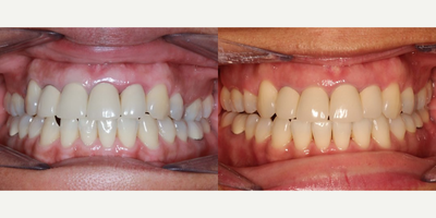 Woman treated with Braces - Woman treated with Braces.